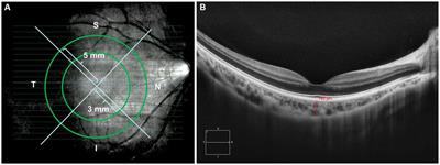 Choroidal thickness in relation to diopter and axial length among myopic children